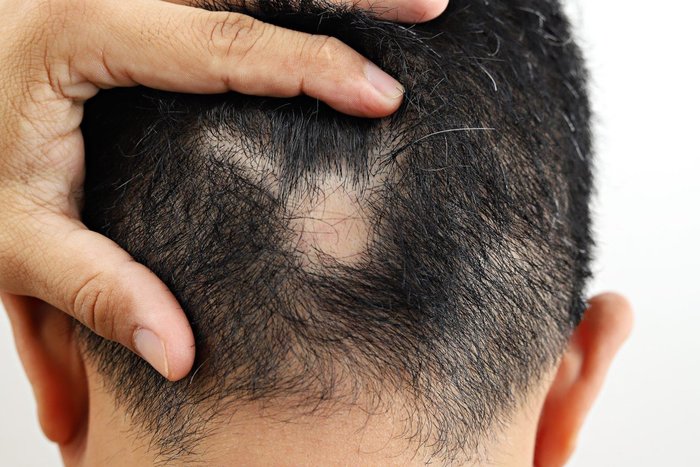 sackiran-alopesi-universalis-nedir-sackiran-belirtileri-neler-tedavisi-var-mi-oldurur-mu-1688795846041.jpeg
