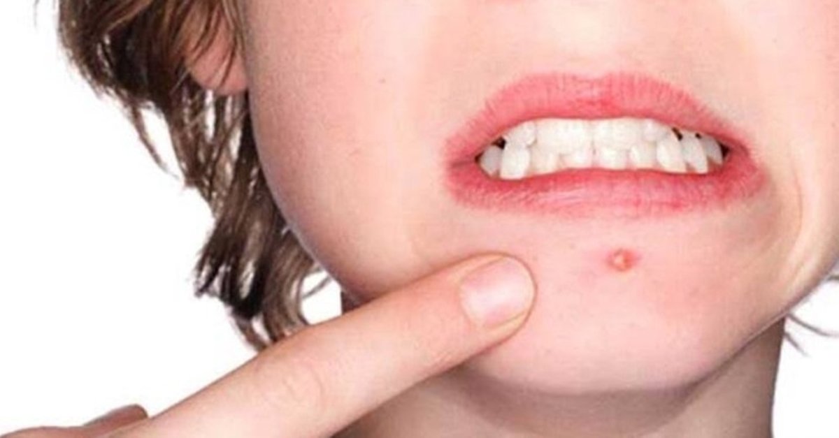 how to get rid of pimple on lip ?