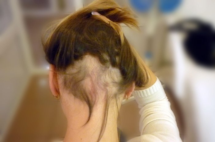sackiran-alopesi-universalis-nedir-sackiran-belirtileri-neler-tedavisi-var-mi-oldurur-mu-1688795867346.jpeg