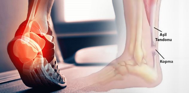 Aşil tendonu nedir? Tedavisi var mı? Aşil tendonu sakatlığı hakkında bilgiler...