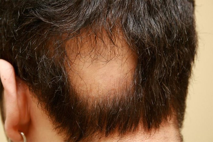 sackiran-alopesi-universalis-nedir-sackiran-belirtileri-neler-tedavisi-var-mi-oldurur-mu-1688795847266.jpeg